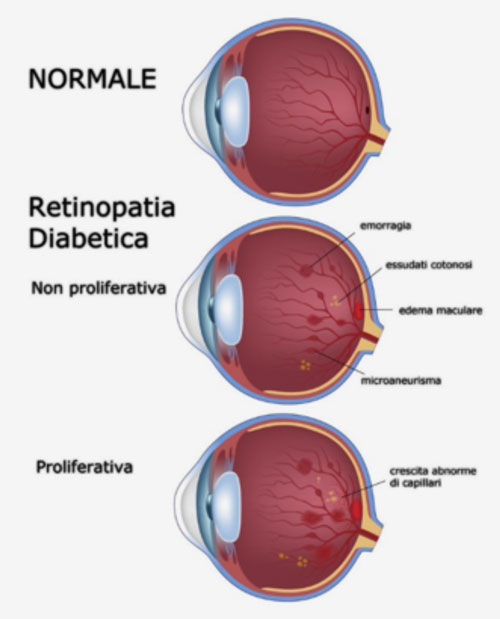 Maculopatia6