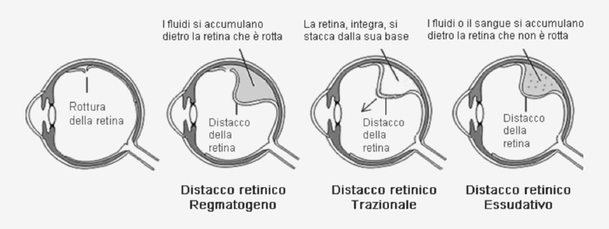 distacco2