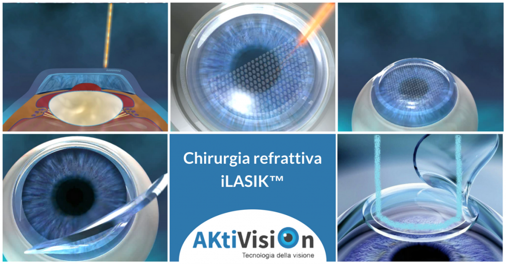 Chirurgia refrattiva iLASIK™ per correggere i difetti visivi - Aktivision - Aktivision Blog