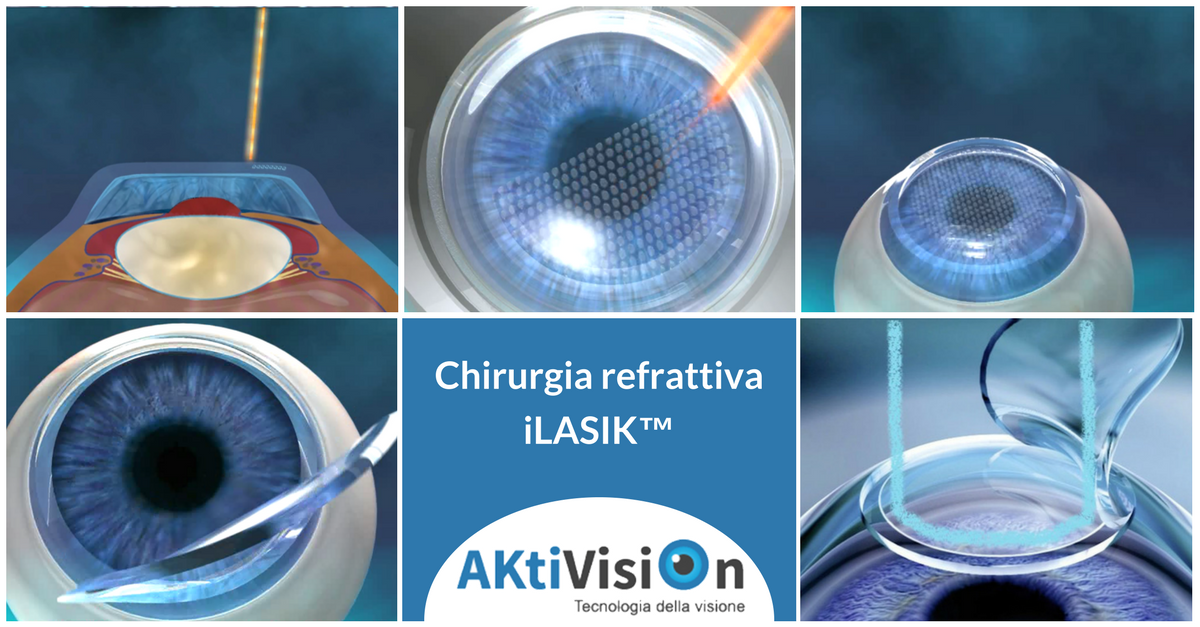Chirurgia refrattiva iLASIK™ per correggere i difetti visivi - Aktivision - Aktivision Blog