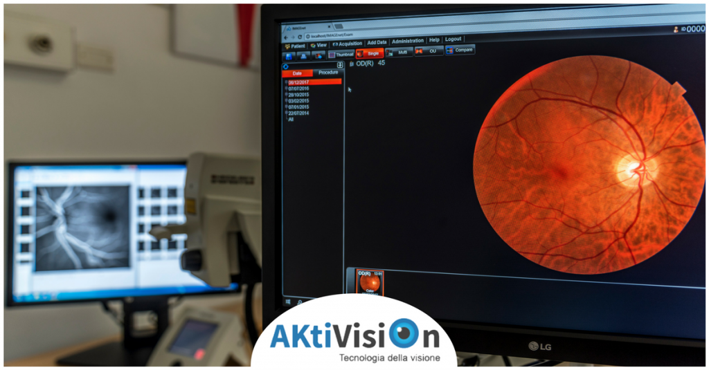 Distacco di retina, i sintomi da non sottovalutare - Aktivision Blog