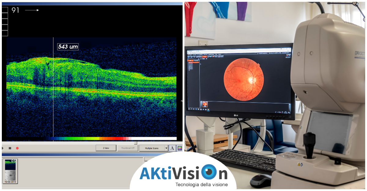Screening retinico - Aktivision Blog